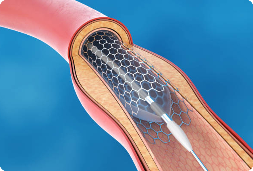 Balloon Angioplasty