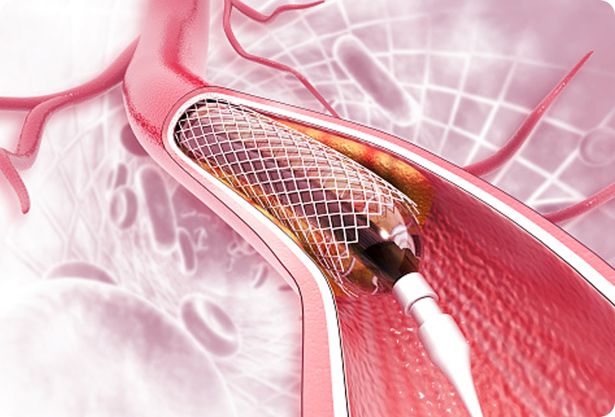 angioplasty surgery cost in india