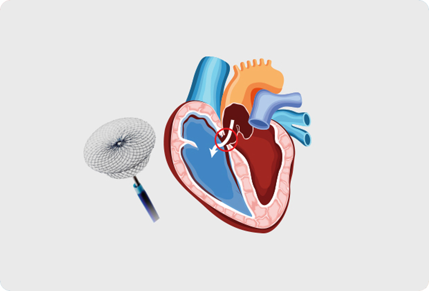 Device Closure of ASD (Amplatzer Septal Occluder)