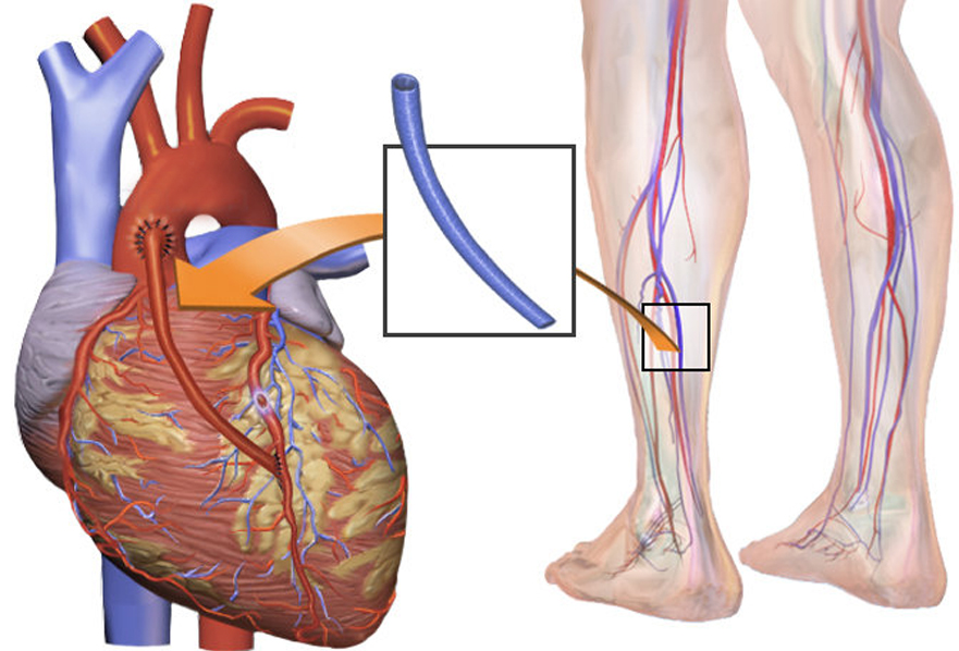 Heart-Bypass-Surgery