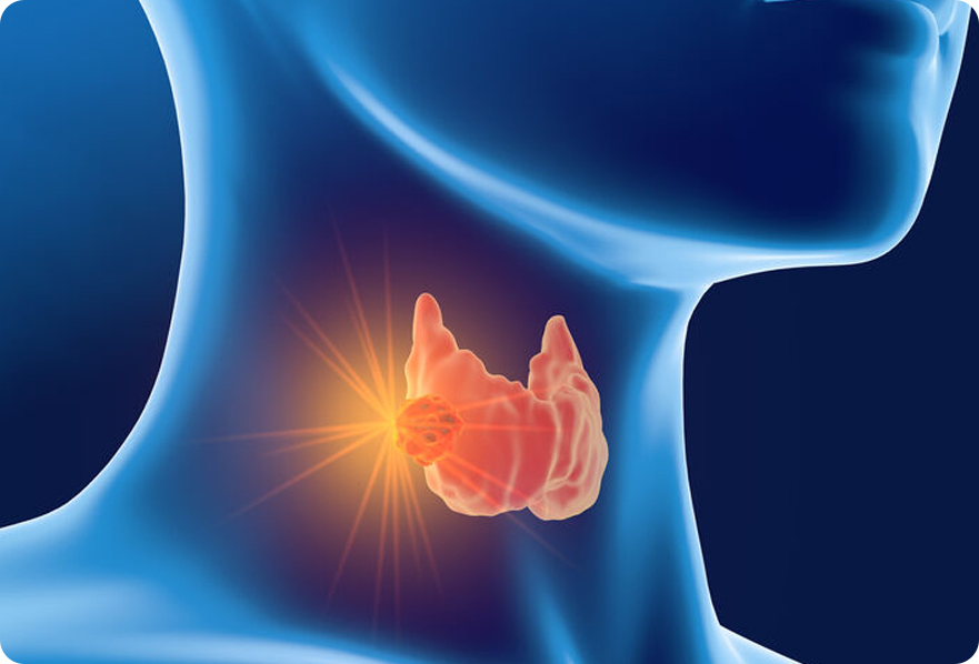 Papillary-Thyroid-Cancer