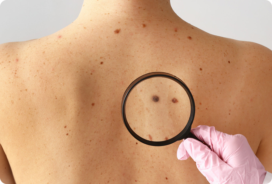 Skin Cancer Treatment